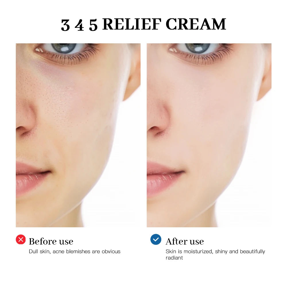 Crema 345 Relief: El Tratamiento Antiglicación (Anti-Azúcar) que Reduce las Marcas de Acné e Ilumina la Piel.